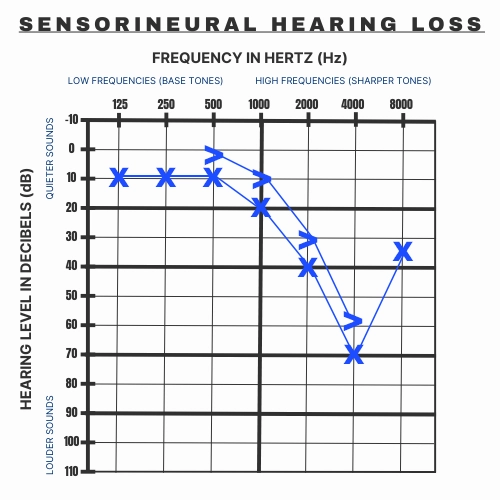 An example of what Sensorineural Hearing Loss looks like on an audiogram.